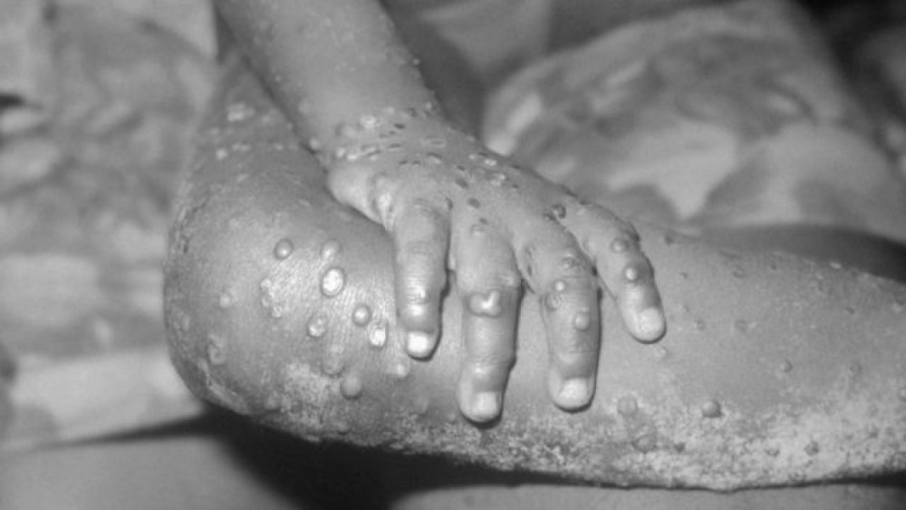 Monkeypox in Nigeria: NCDC Registers 59 Suspected Cases,15 C